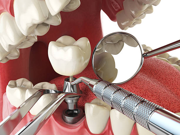 Best Emergency Dentist for Lost Fillings or Crowns in Morgan Hill, CA